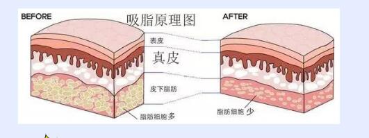盘点2020年深圳吸脂手术价钱情况分析！