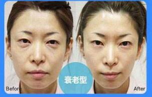 溶脂去眼袋手术价格是多少？收费标准解析！
