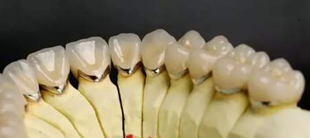 牙齿修复小课堂：钴铬合金烤瓷牙材质的优劣点分析！