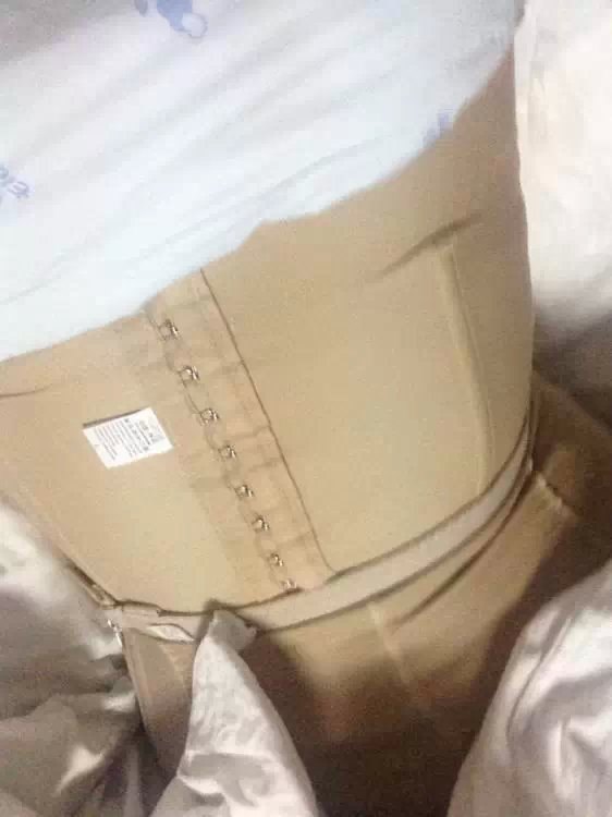 腰部环形抽脂吸脂减肥术后分享