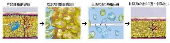 提臀瘦腿这个方法真的很管用：吸脂手术