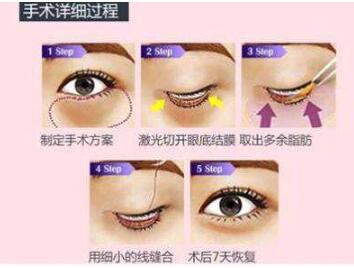 眼袋整型的方式有哪些？各自的果怎么样？