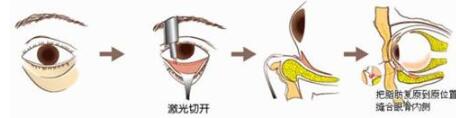 眼袋整型的方式有哪些？各自的果怎么样？