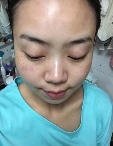 oe光子嫩肤价格、调节原理以及美肤介绍来啦！