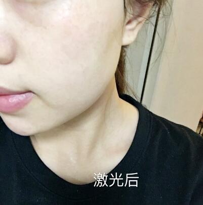 oe光子嫩肤价格、调节原理以及美肤介绍来啦！