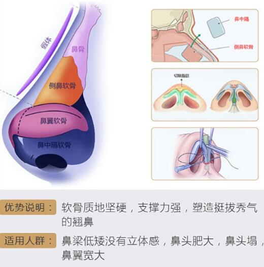 自体软骨移植隆鼻术没问题吗？揭开手术真相的面纱……