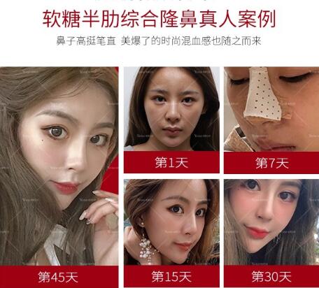 自体软骨移植隆鼻术没问题吗？揭开手术真相的面纱……