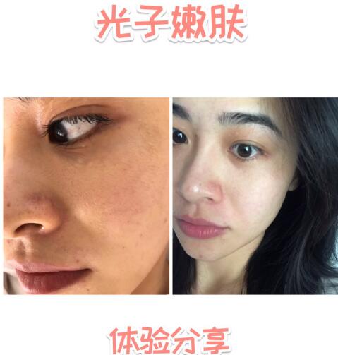 林秋蓉医生做光子嫩肤体验过程心得分享 嫩如布丁！