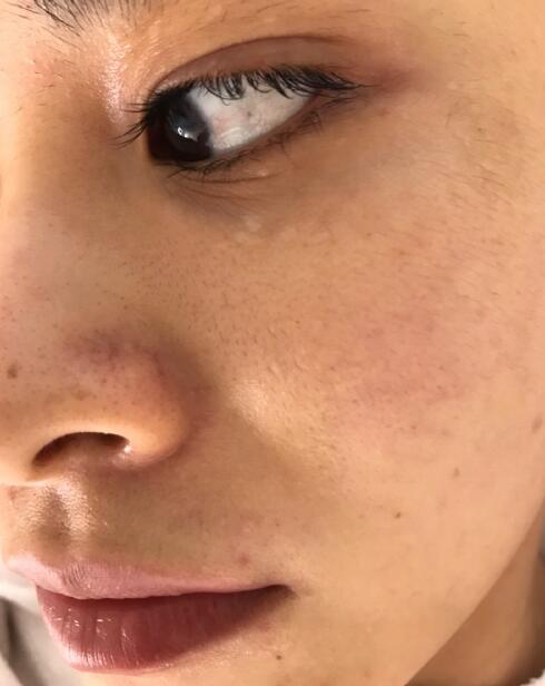 林秋蓉医生做光子嫩肤体验过程心得分享 嫩如布丁！