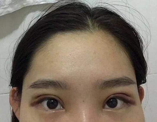 韩式or欧式双眼皮哪个好？看我做的韩式自然款双眼皮100分