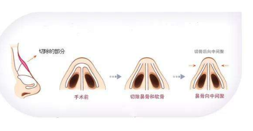 驼峰鼻整形一定要磨鼻梁骨吗？鼻型不一定要一定笔直！