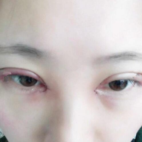 张晓棠医生 个人简介 眼部手术整形案例图来辣