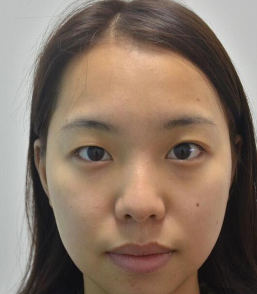 北京生物焊接双眼皮原理是什么？术前术后果！