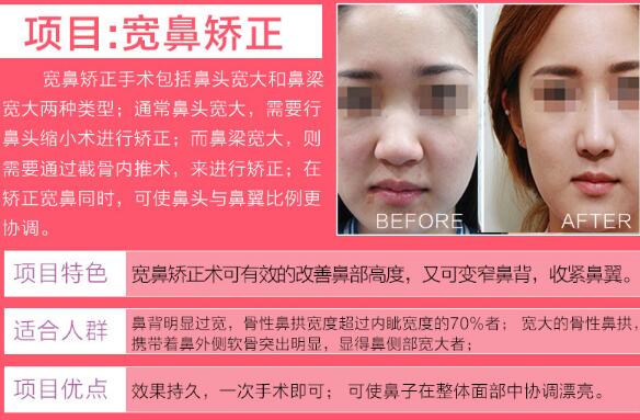 鼻骨缩窄术让我get仙女美鼻，手术简单果不简单！