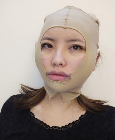 杭州时光下颌角截骨手术整形果分享|脸型改变记