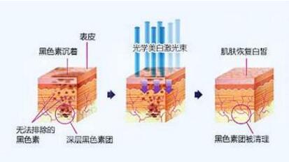 彩光嫩肤要多少钱