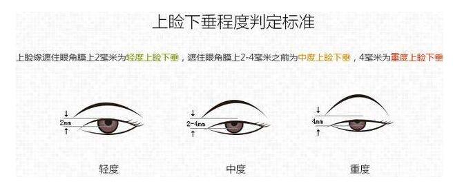 眼睛无论怎么睁开都不大 其实都是上睑下垂影响的