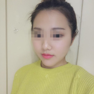 膨体垫下巴 变美