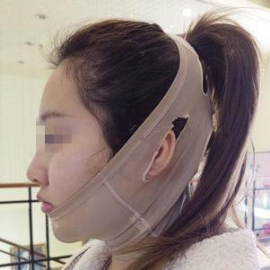膨体垫下巴 变美