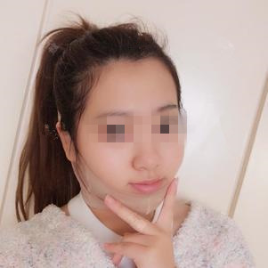 膨体垫下巴 变美