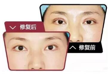 北京微丽整形医院双眼皮修复手术的特点 恢复双眼动态的美感