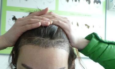 广州植发哪里好 广州植德植发医院头发种植果能保持多久