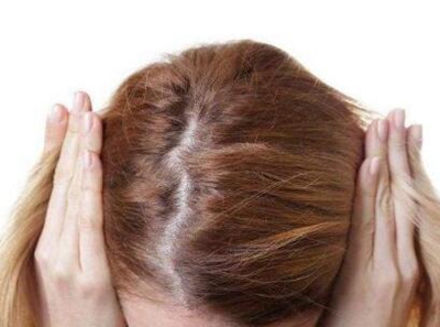 女性脱发怎么办 昆明新生植发专家为您支招