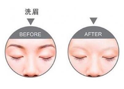 重获美丽肌肤——激光洗眉干净与否取决于三大要素