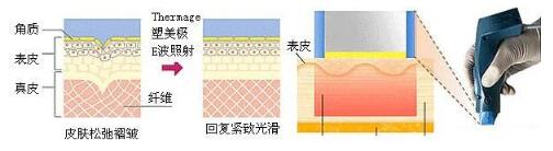 网红抗衰项目热玛吉