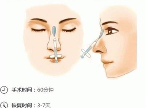 做自体脂肪隆鼻可能会变宽吗?危害什么