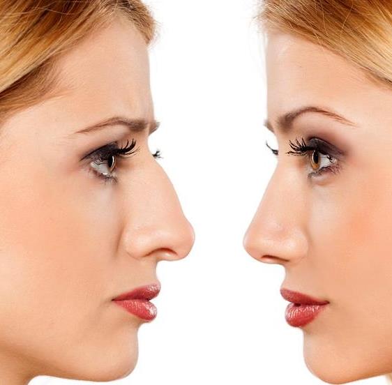 隆鼻和鼻部手术有什么不同？选择哪一种手术方式更好？