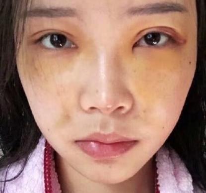 在扬州苏北人民医院整形科做了面部填充，果分享
