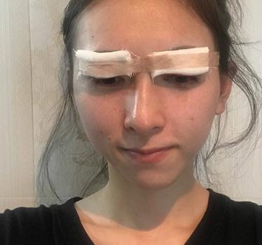 美女在松原花都美容院割双眼皮，两个月后很喜欢