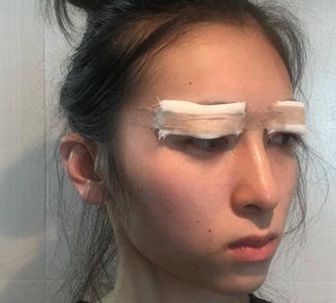美女在松原花都美容院割双眼皮，两个月后很喜欢