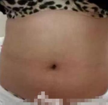 武汉同济医院整形科吸脂瘦腰腹果展示，术后三个月图片对比分享