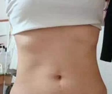 武汉同济医院整形科吸脂瘦腰腹果展示，术后三个月图片对比分享