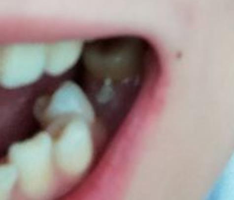 济南市立医院牙齿种植果如何？案例术后恢复分享