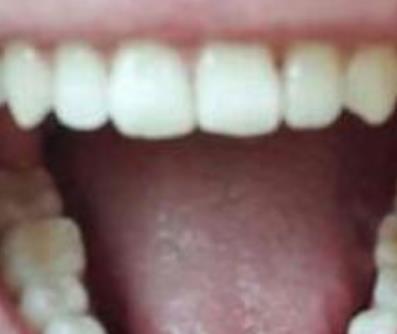 北大口腔正畸怎么样？牙齿矫正8个月经历分享