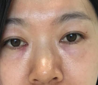 青医附院匡瑞霞技术怎么样？看祛眼袋前后图