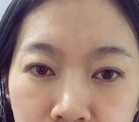 青医附院匡瑞霞技术怎么样？看祛眼袋前后图
