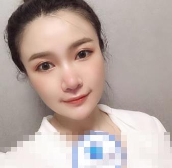 选择依谋医疗美容院割双眼皮不后悔，恢复后特别有神