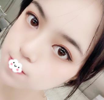 北京赵延勇医生口碑好吗？双眼皮介绍果公布