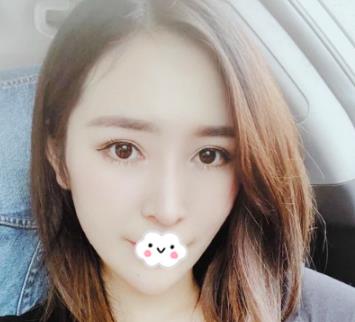 上海gk整形医院做鼻子恢复，两个月的护理变气质宝宝