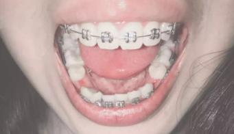 【介绍】北京劲松口腔牙齿矫正怎么样？一个月复诊牙齿有所改变