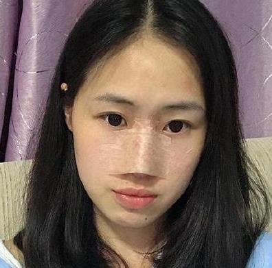 中山大学第一附属医院整形外科做隆鼻3个月后，摆脱塌鼻妹