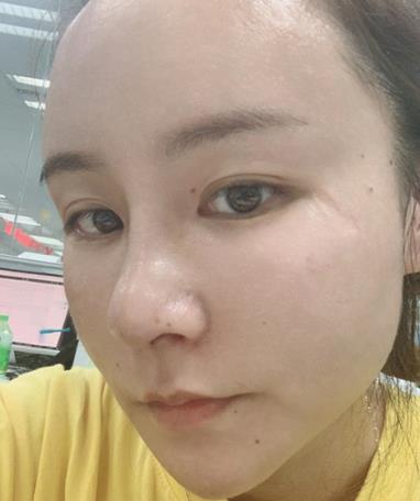 【胡守舵】面部吸脂+隆鼻介绍，两个月