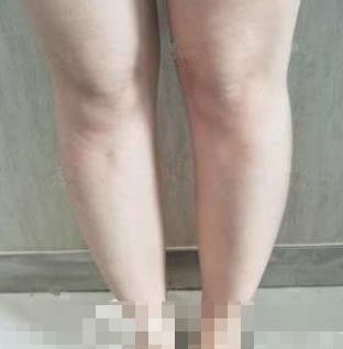 悉尼整形医院抽脂果怎么样？瘦腰腹后前后图