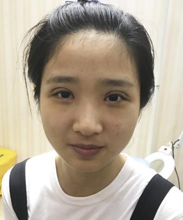 深圳北大李天石双眼皮案例分享：给了很大的改变，颜值上升