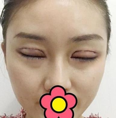 滨州市人民医院美容科双眼皮介绍，眯眯眼变成大眼睛了