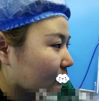 旭美整形医院面部抽脂介绍，小V型脸恢复经验分享